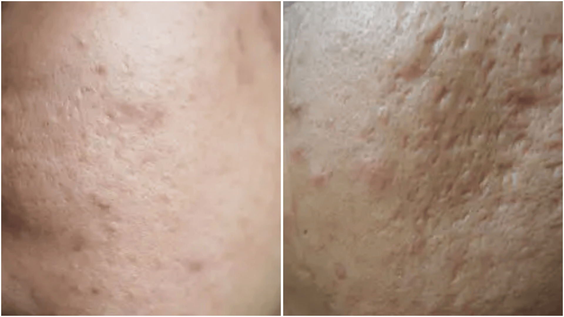 acne mark vs acne scar