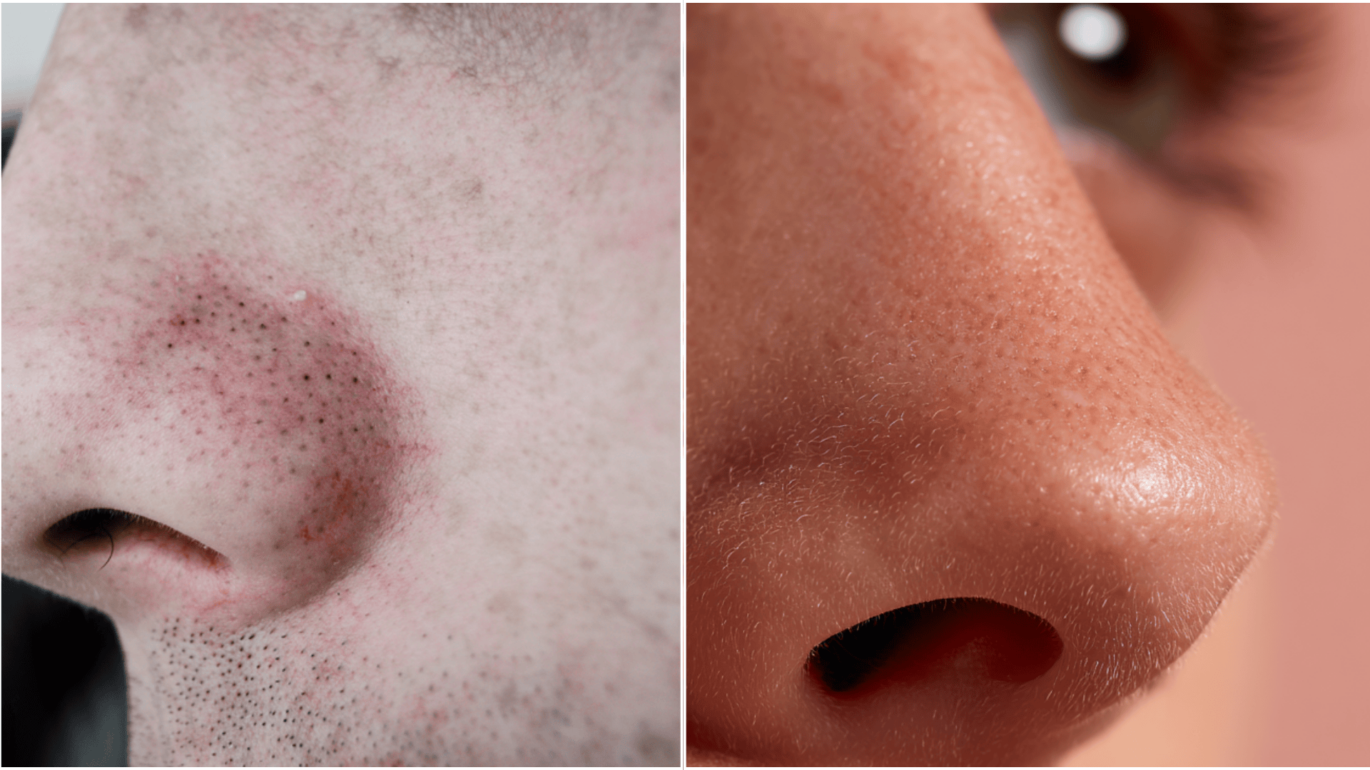 blacheads vs sebaceous