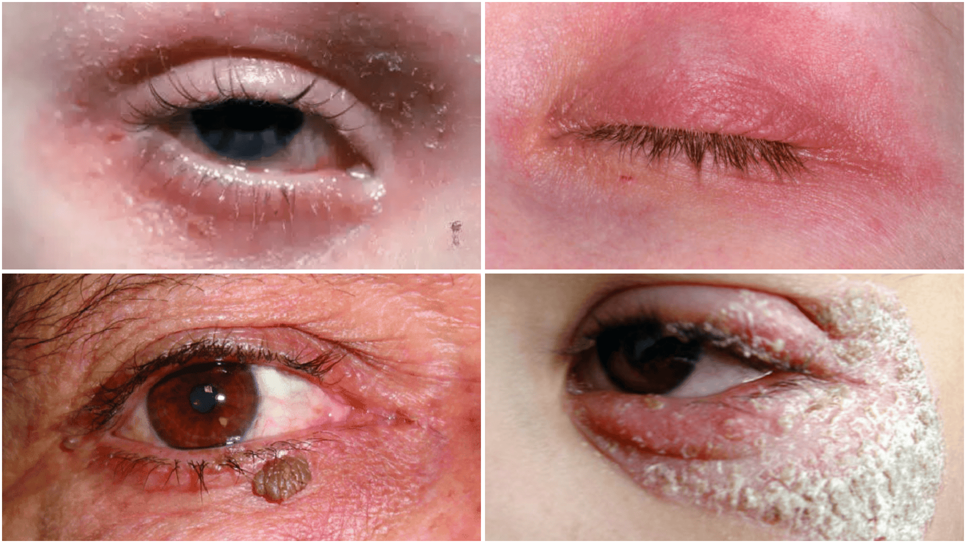 Health Factors Behind Eye Dryness