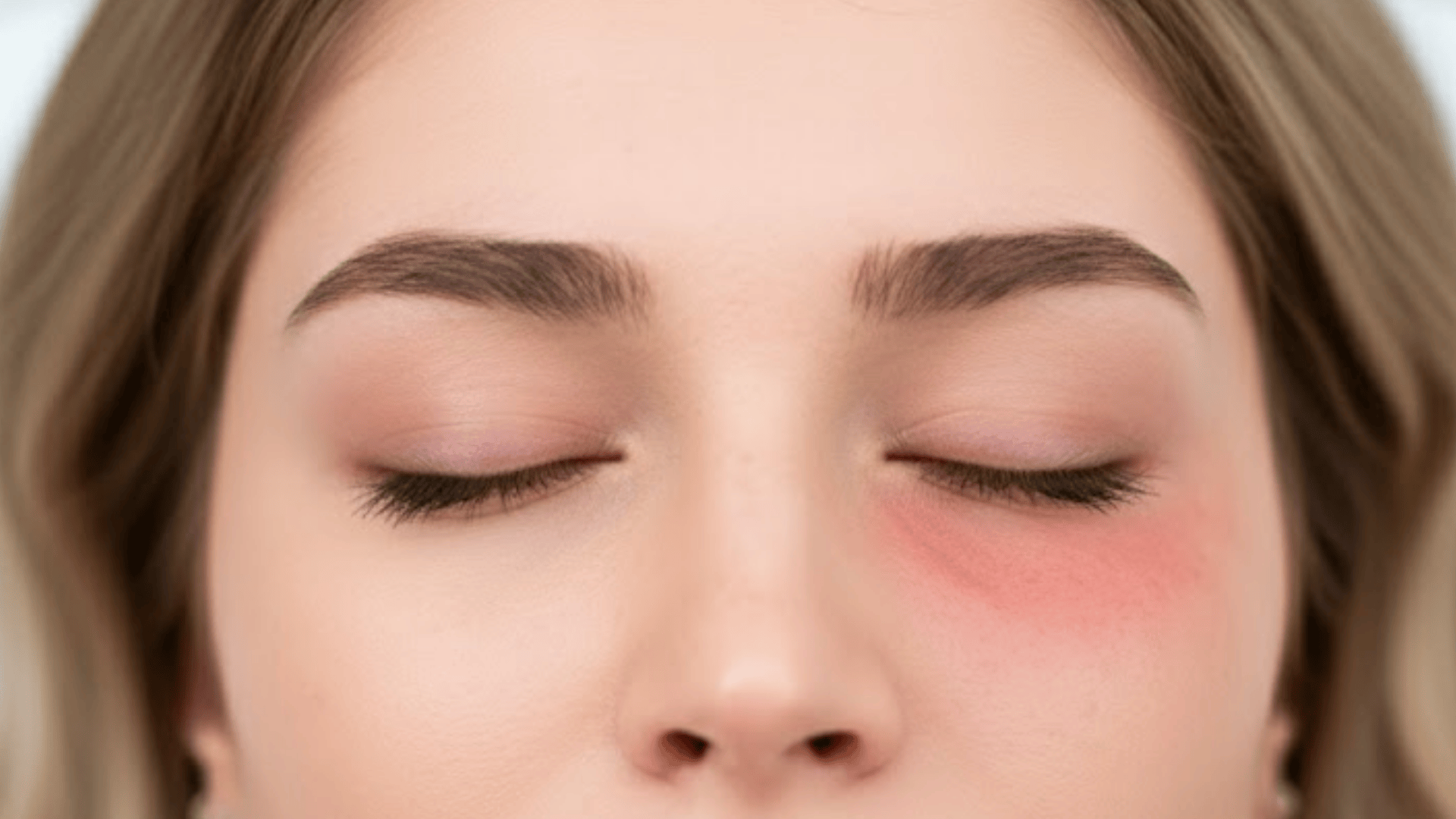 Side Effects of PRP Under Eyes Treatment