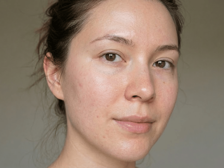 Azelaic Acid Before and After: What to Expect - Copenhagen Fashion Summit