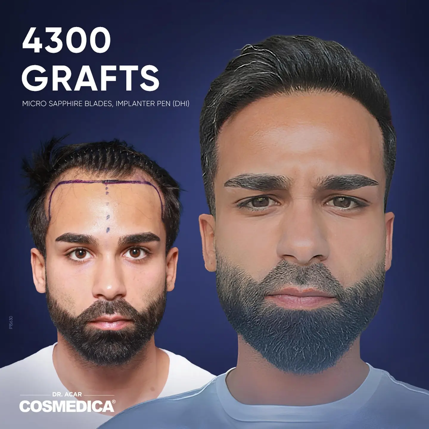 Before and after images showing a man's hair transplant results against a blue background