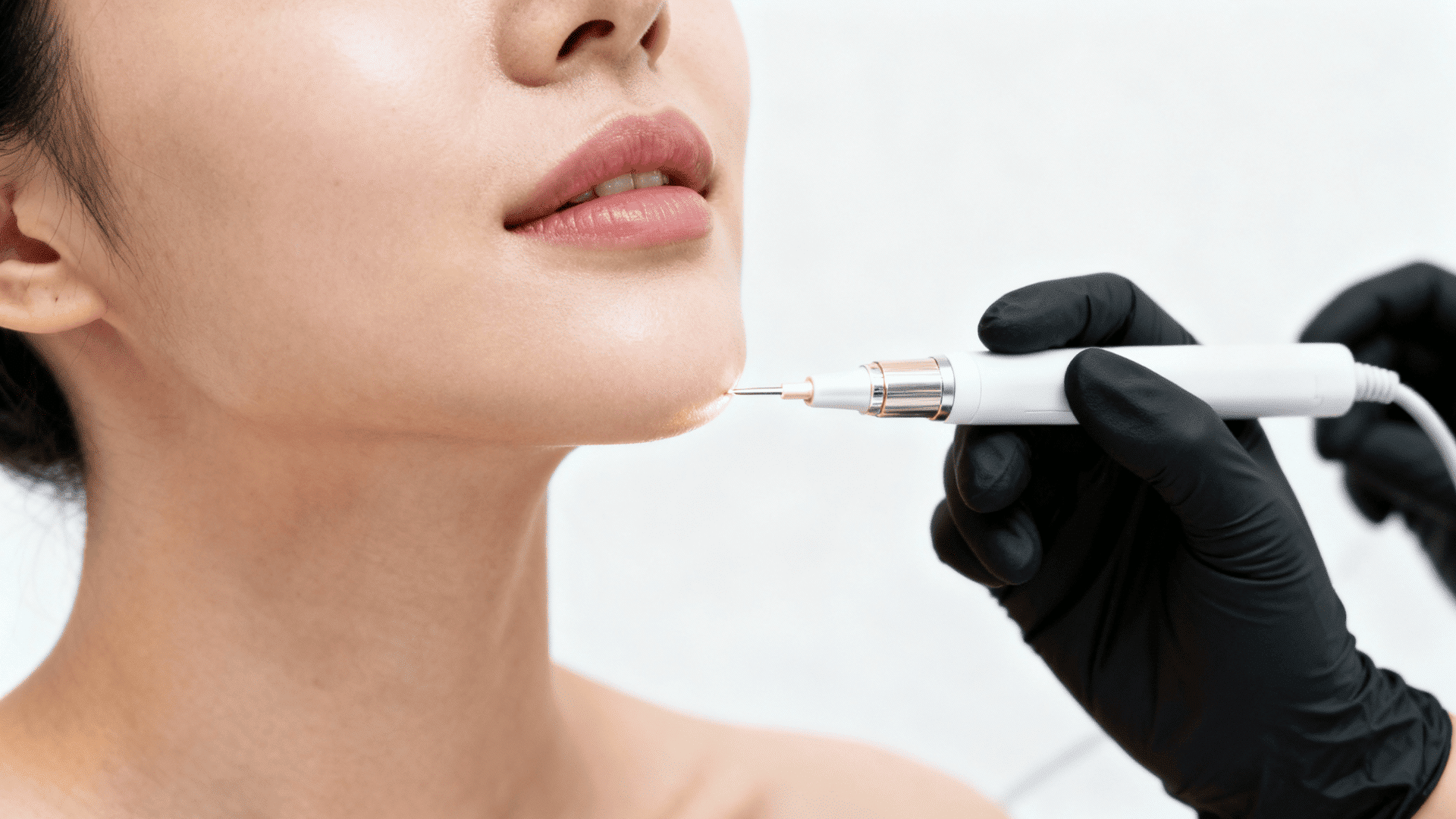 Close-up of facial electrolysis treatment on a woman’s chin at a skincare clinic.