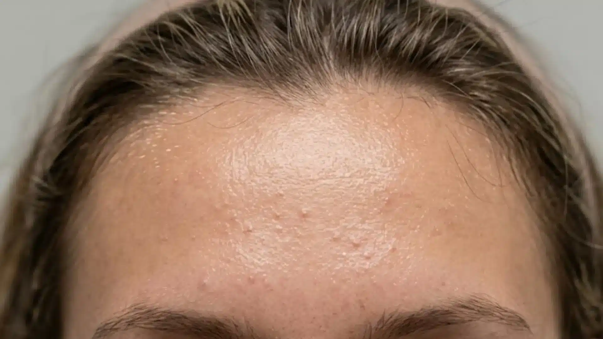 Close-up of a forehead with small bumps, clogged pores, and mild acne caused by excess oil and skin buildup.